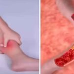 High Cholesterol Symptoms: Warning Signs Your Body May Show