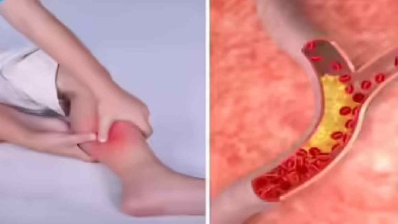 High Cholesterol Symptoms: Warning Signs Your Body May Show