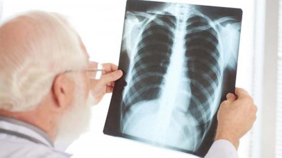 Doctors Reveals Real Cause Of High Pneumonia Cases This Winter