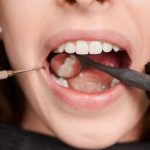 Top Foods Causing Cavities: What You Should Stop Eating Now