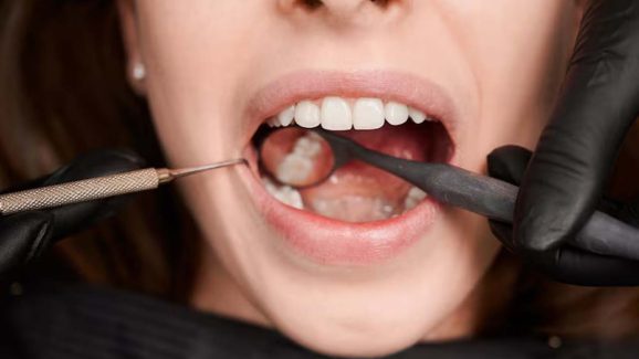 Top Foods Causing Cavities: What You Should Stop Eating Now