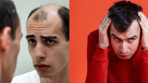 Male Hair Loss Could End: Simple Drug Shows 500% Improvement